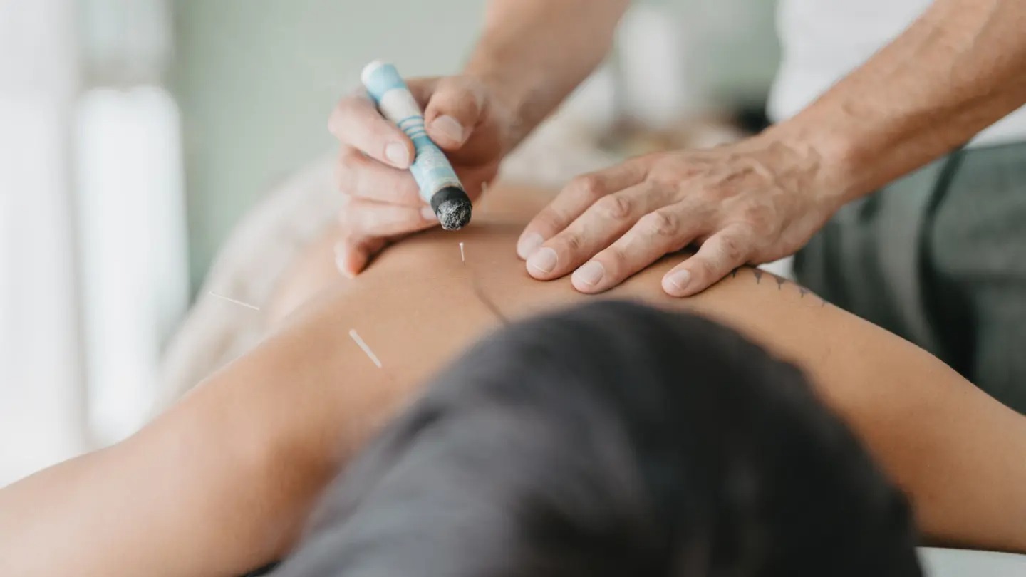 Moxa sticks used for heat therapy