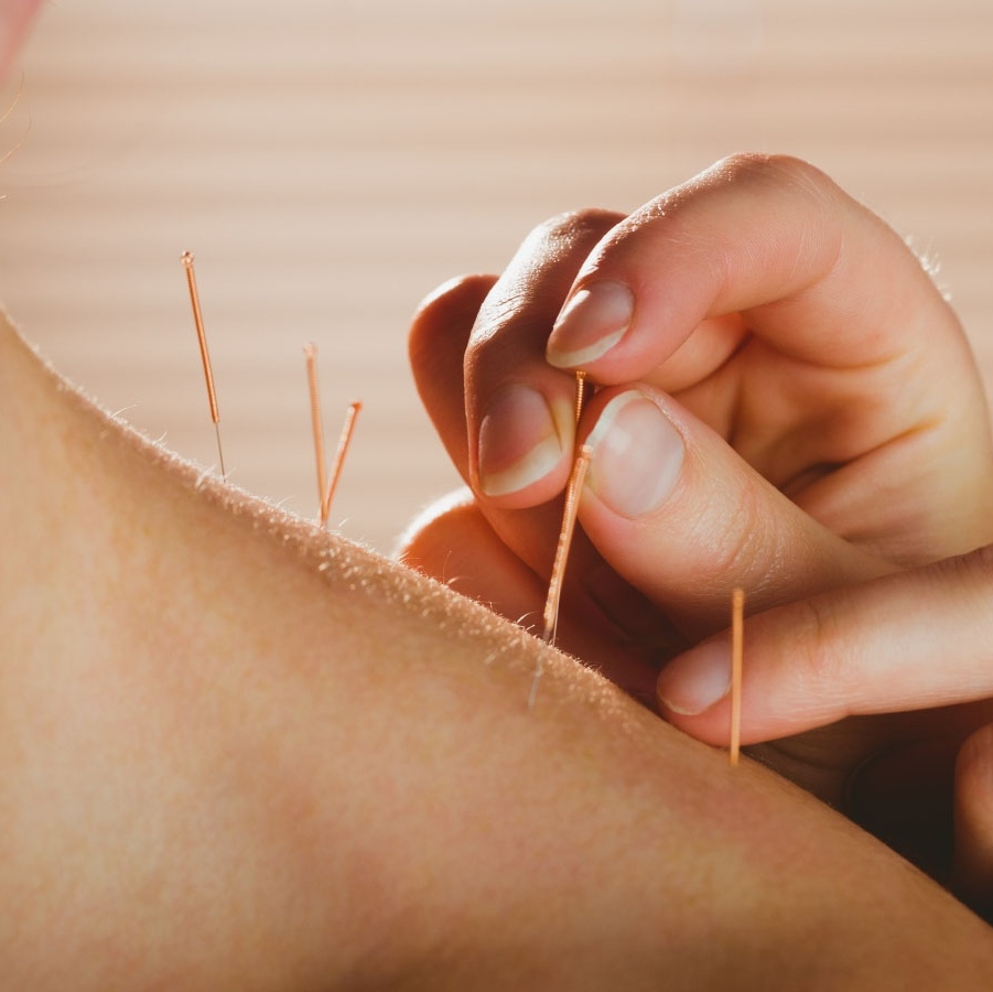 Acupuncture needles on skin