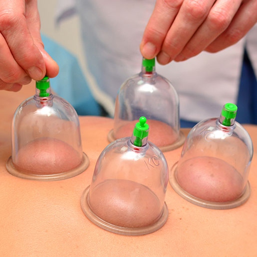 Cupping therapy on a person's back